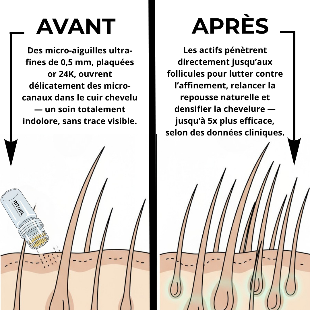 Technologie Capillaire  Micro-infuse®