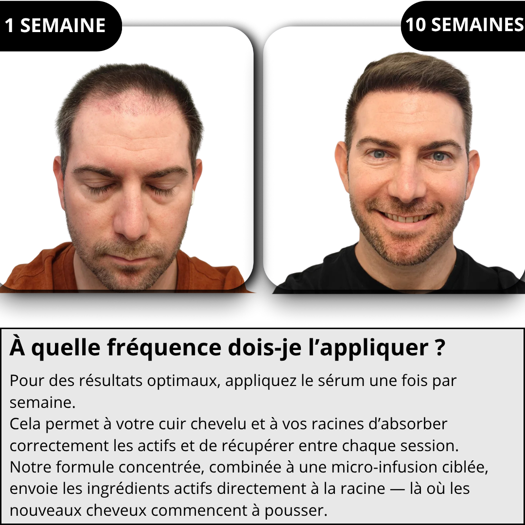 Technologie Capillaire  Micro-infuse®