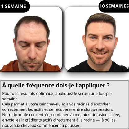 Technologie Capillaire  Micro-infuse®